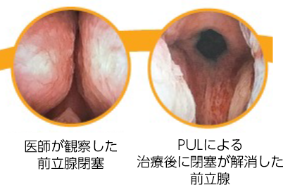 前立腺