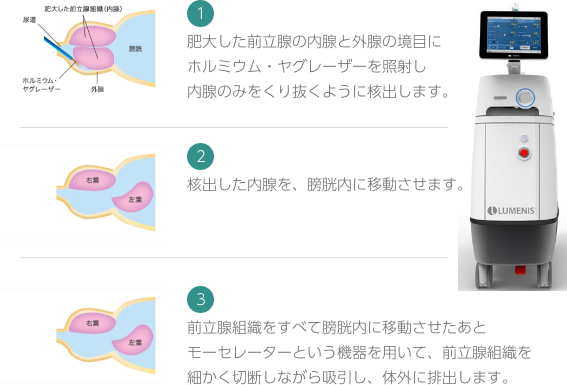 レーザ核出術